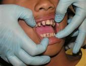 洗牙后门牙隐裂像碎了的危害 洗牙后门牙隐裂像碎了要如何治疗