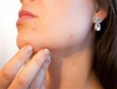 引发接触性皮炎的原因有哪些 接触性皮肤炎患者该如何治疗