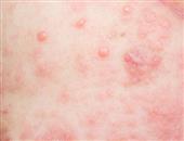 梅毒的初期症状有哪些 感染梅毒后的保健措施