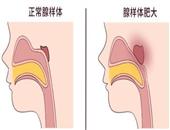 如何治疗腺样体肥大？治腺样体偏方