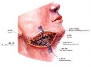 急性颌下腺炎