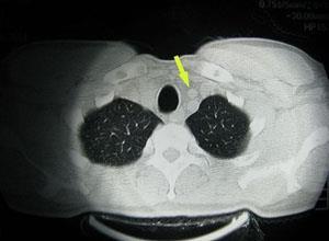 胸腺瘤