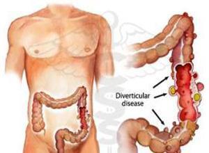 结肠脂肪瘤
