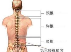 第三腰椎横突综合征