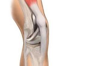 膝关节创伤性滑膜炎
