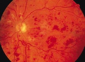 视网膜病变