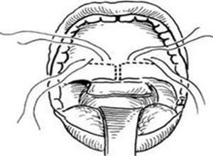 先天性鼻咽部狭窄及闭锁