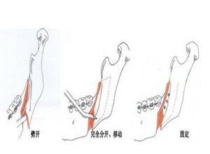 下颌后缩