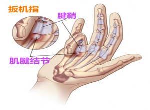 手指屈肌腱鞘炎