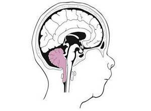小脑扁桃体下疝畸形
