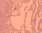肝海绵状血管瘤