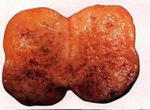多发性内分泌腺瘤Ⅱ型