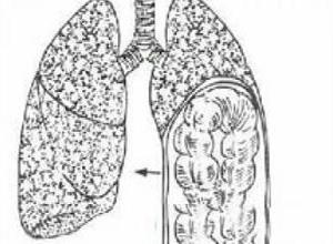 肺疝