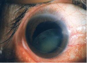 继发于无晶状体眼和人工晶状体眼的青光眼
