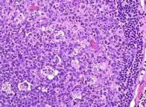 Ⅱ型免疫母细胞性淋巴腺病