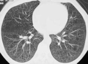 肺组织细胞增生症