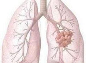过敏性支气管肺曲霉病