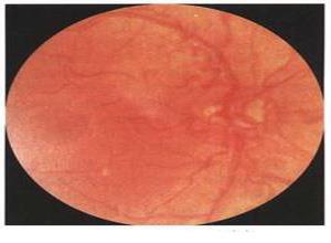 红细胞增多症视网膜病变