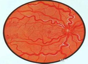 红细胞增多症眼底
