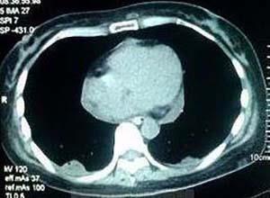 颅后窝室管膜瘤
