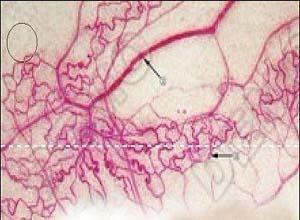 毛细血管或静脉血栓形成