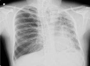 先天性肺发育不全