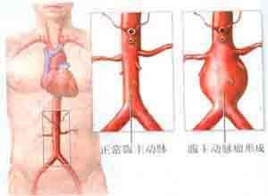 腹主动脉血栓形成综合征