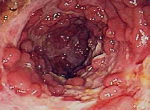 小肠腺瘤