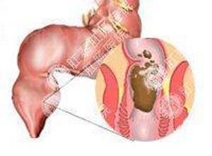 小肠原发性恶性淋巴瘤
