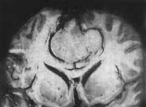 小脑脑桥角脑膜瘤