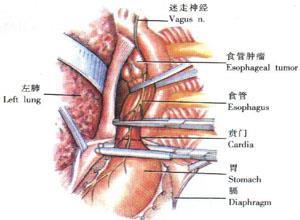 胸导管损伤