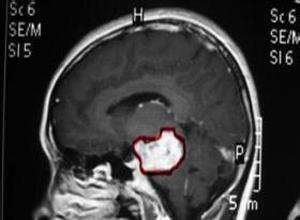 岩骨斜坡脑膜瘤
