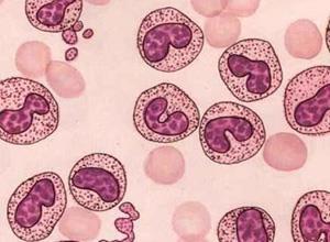幼淋巴细胞白血病