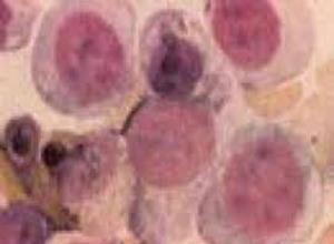 幼年型粒-单核细胞白血病