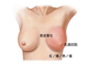 早期乳腺癌
