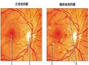 珠蛋白生成障碍性贫血视网膜病变