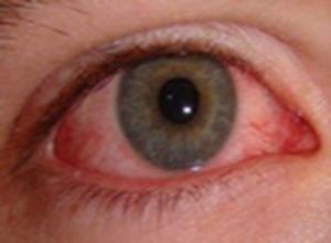 过敏性眼睑皮肤炎