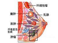 乳腺脂肪瘤