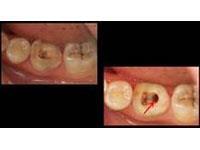 慢性牙髓炎