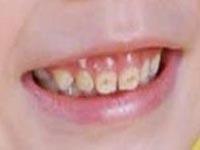 牙斑