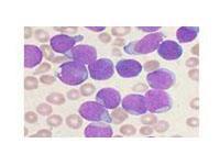 慢性粒单核细胞白血病