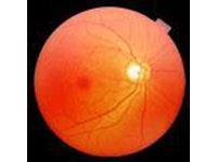 视网膜震荡