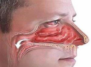 鼻咽炎