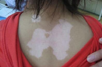 谈谈白癫风患者的膳食食疗