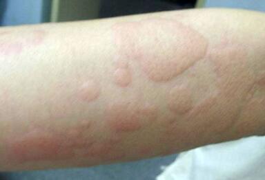 缓解皮肤瘙痒的两大药膳食疗方