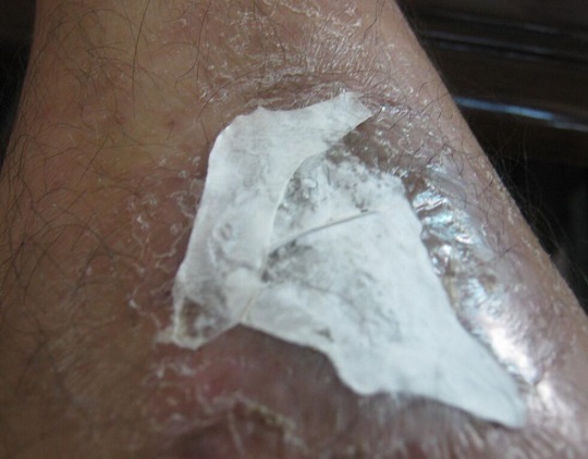 专家指出用达克宁四大误区