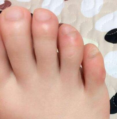 孕妇孕期水肿怎么办 如何进行饮食调理