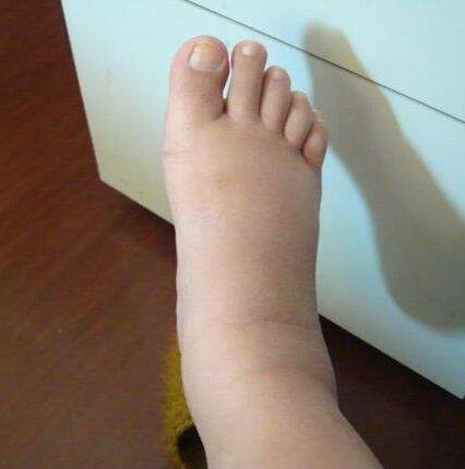 孕期水肿：进食足够蛋白质