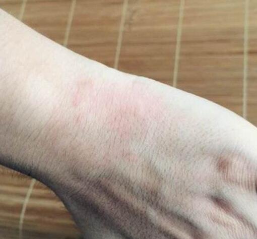 丘疹性荨麻疹的症状及饮食禁忌