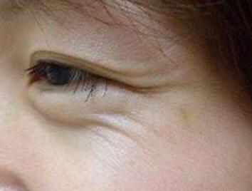 五个饮食小方法 帮助女性去除鱼尾纹